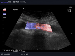 Ultrazvok žil trebuha - abdominalna aorta, normalen izvid